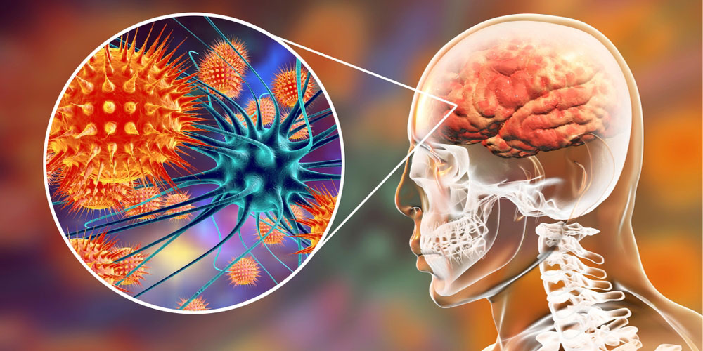 MENINGITE