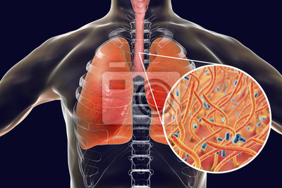 12/11 – Dia Mundial da Pneumonia